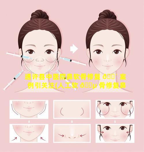 通许县中医院鼻软骨修复 🌴 案例引关注(人工软 🌵 骨修复鼻中隔)